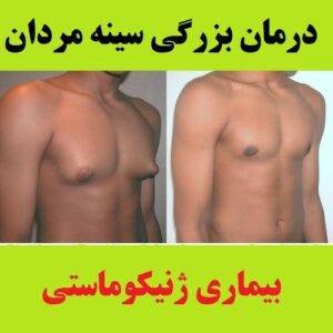 درمان بزرگ شدن سینه در مردان با از بین بردن چربی (ژنیکوماستی)