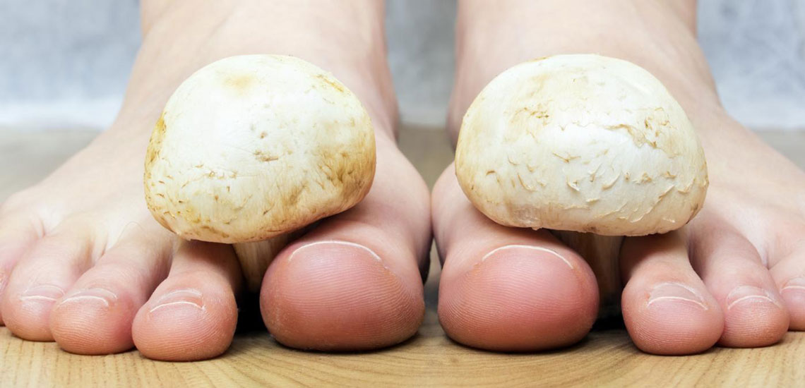 بیماری قارچ پای ورزشکاران