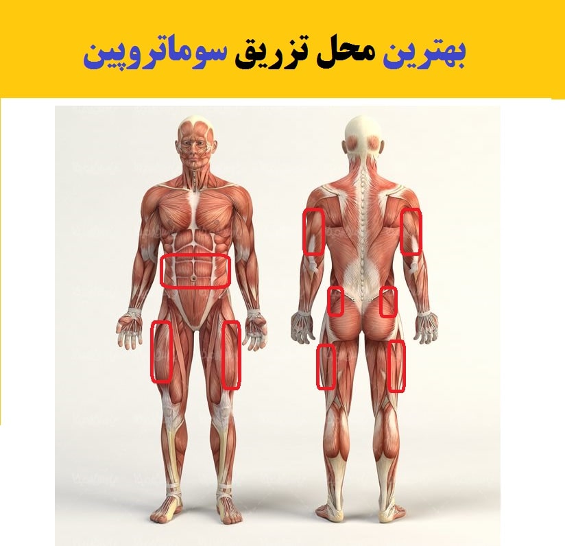 بهترین محل تزریق سوماتروپین